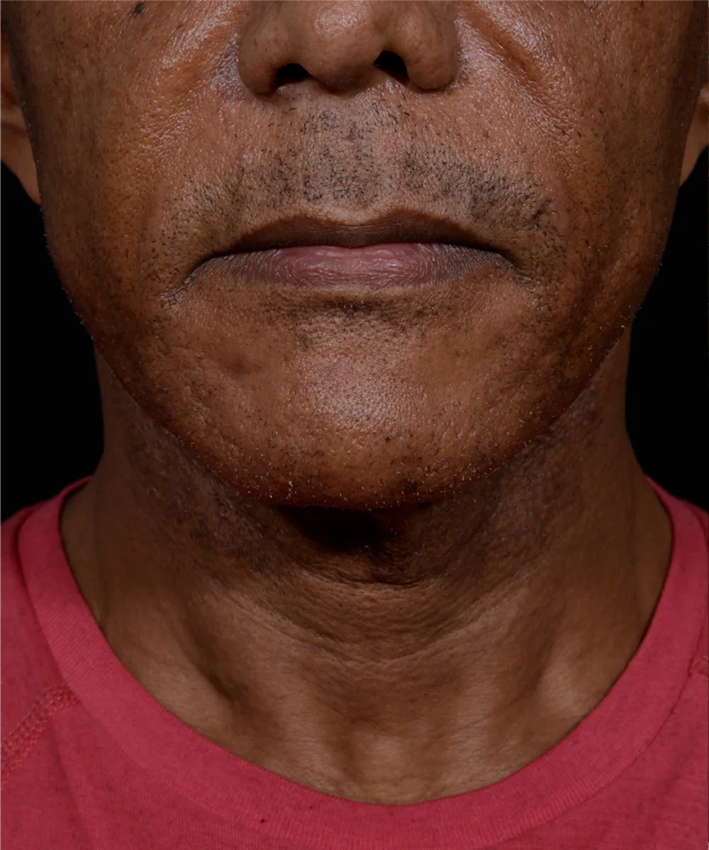 necklift-01-1.webp before