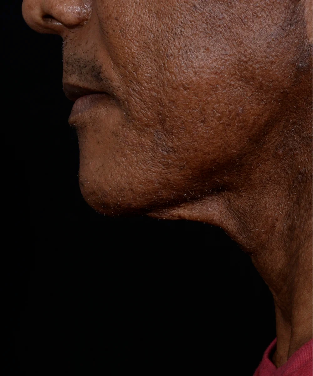 necklift-01-2.webp before