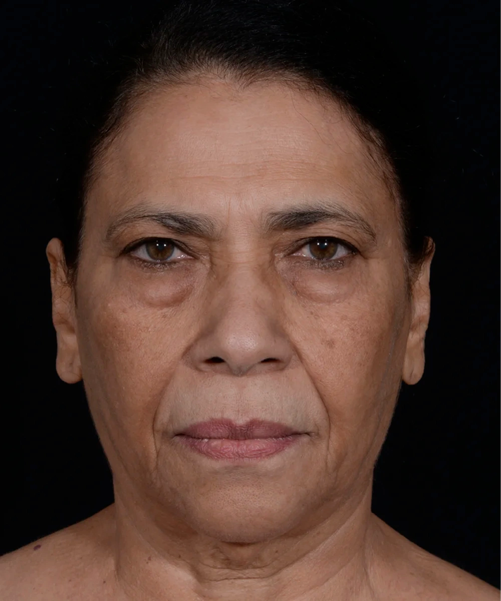 necklift-02-1.webp before