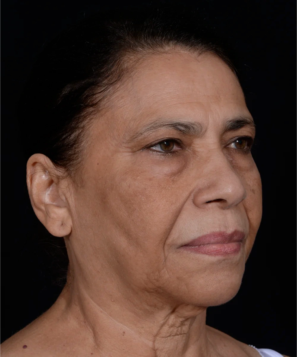 necklift-02-3.webp before