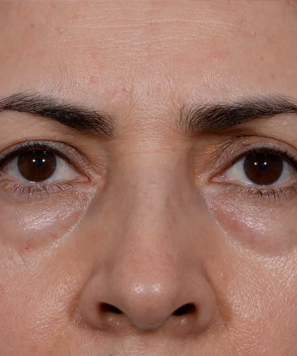 upbleph-01-1.webp before