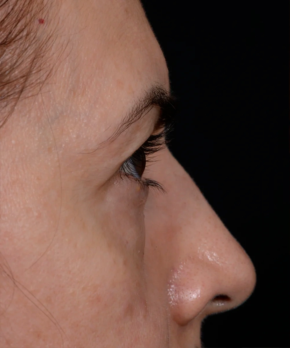 upbleph-01-3.webp after