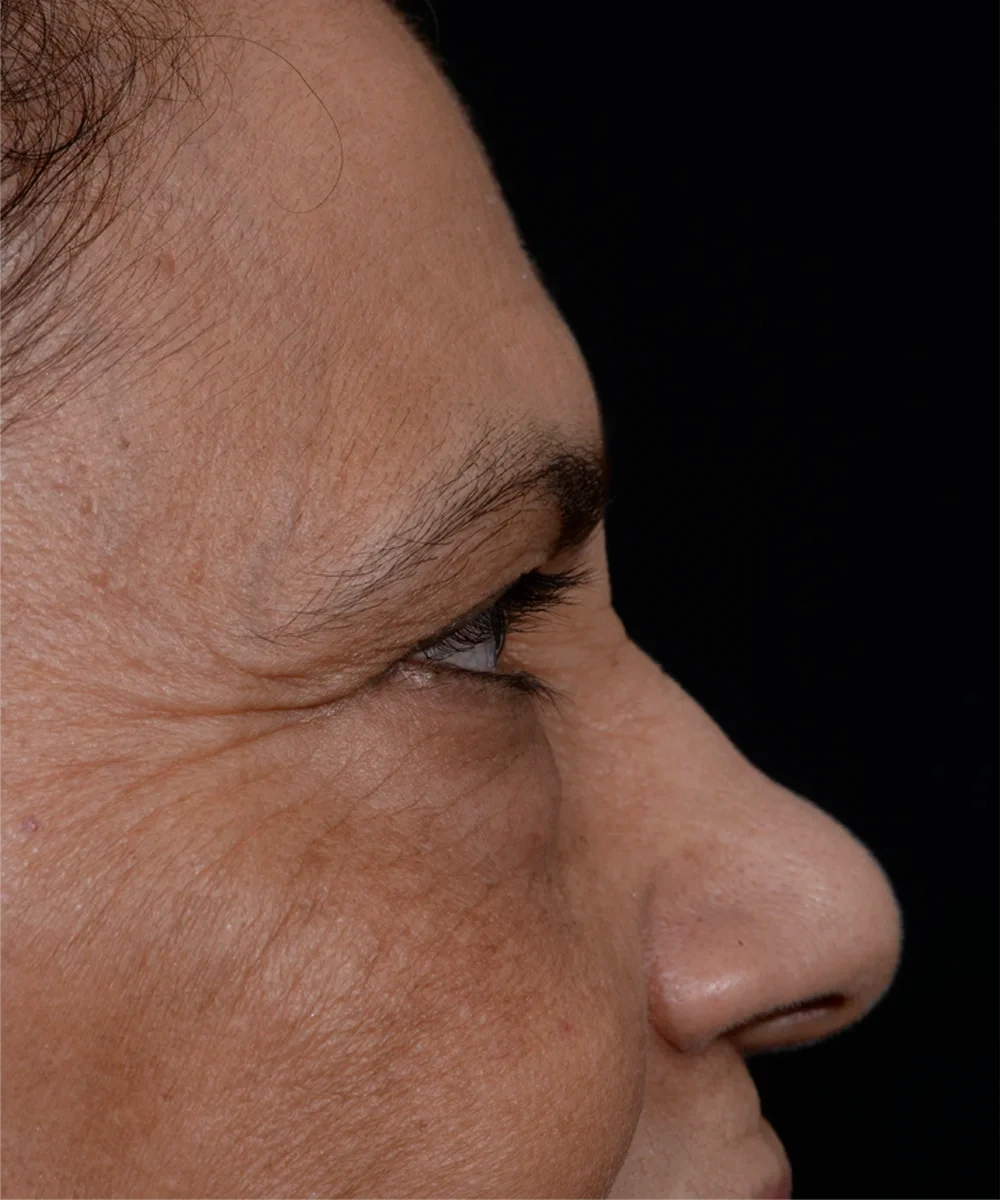 upbleph-02-2.webp before