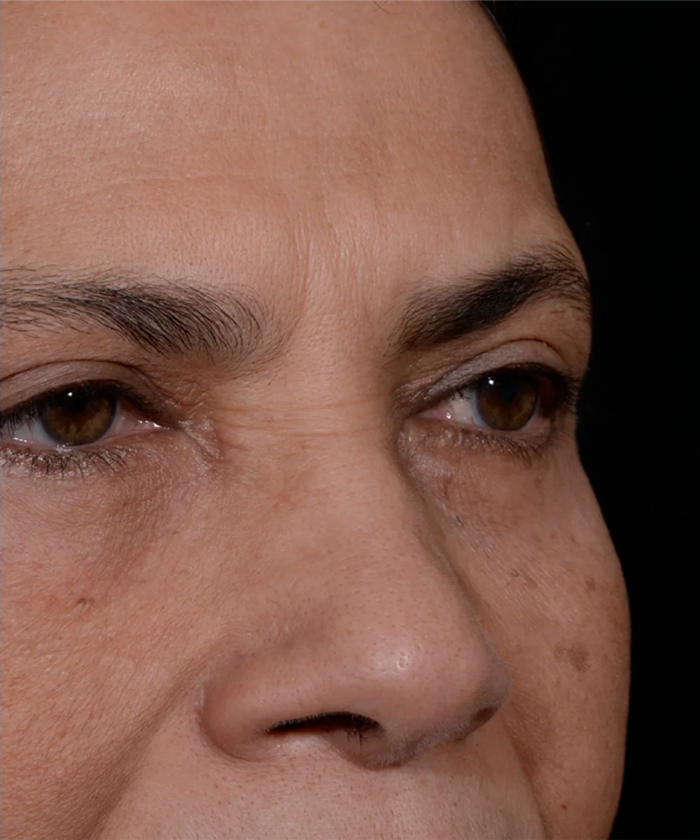 upbleph-02-3.webp after