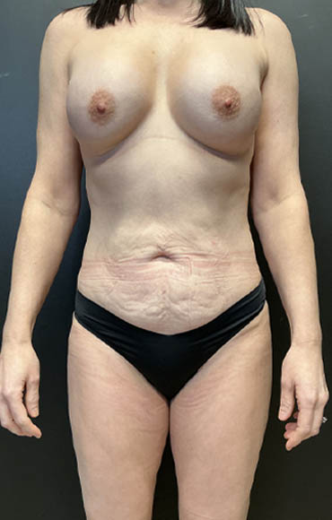 1_0000_BC 1_20_26 Before Anterior.jpg