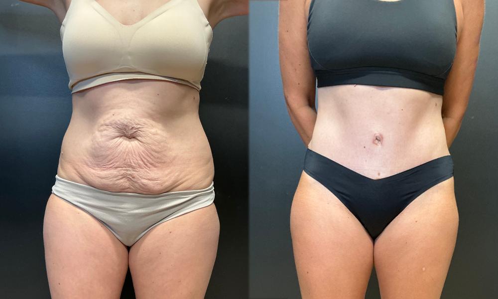 NG Abdominoplasty Before Anterior.jpeg