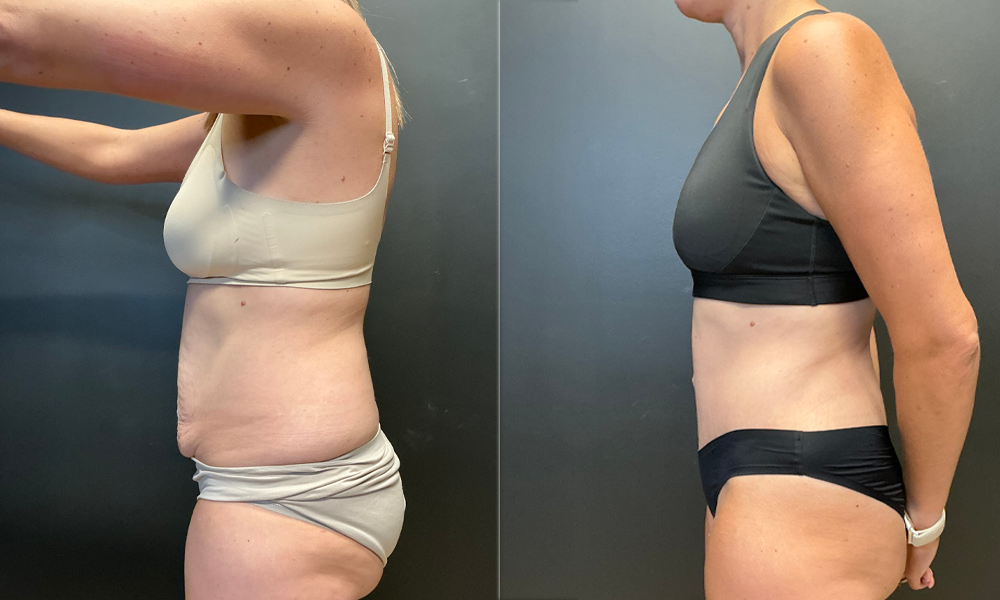 NG Abdominoplasty Before Lateral.jpeg