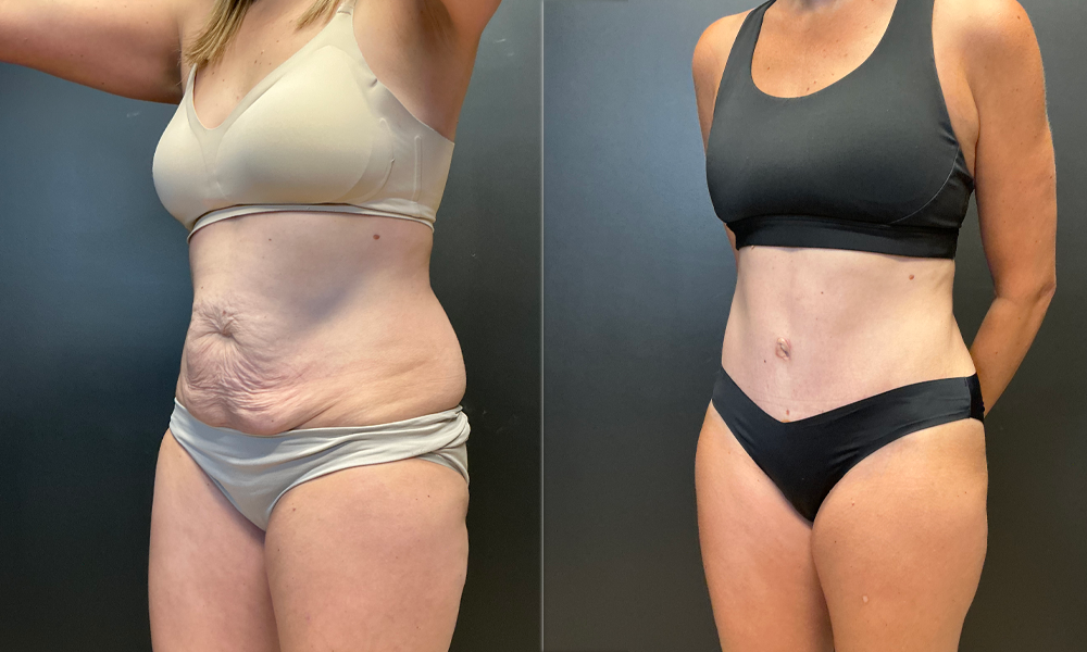NG Abdominoplasty Before Oblique.jpeg