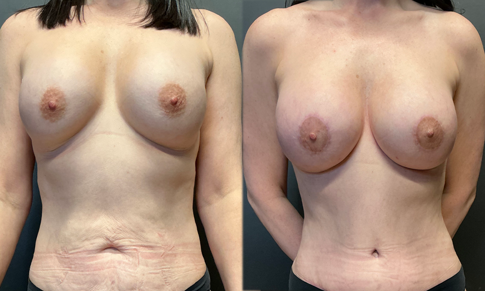 breastaug (1)