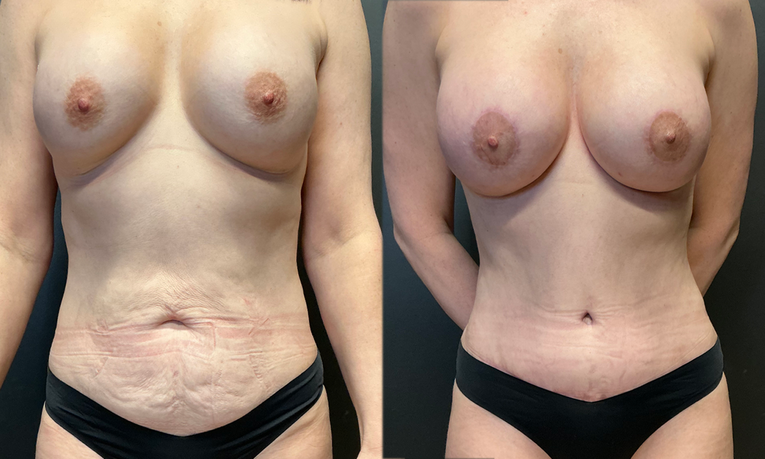 tum (1)