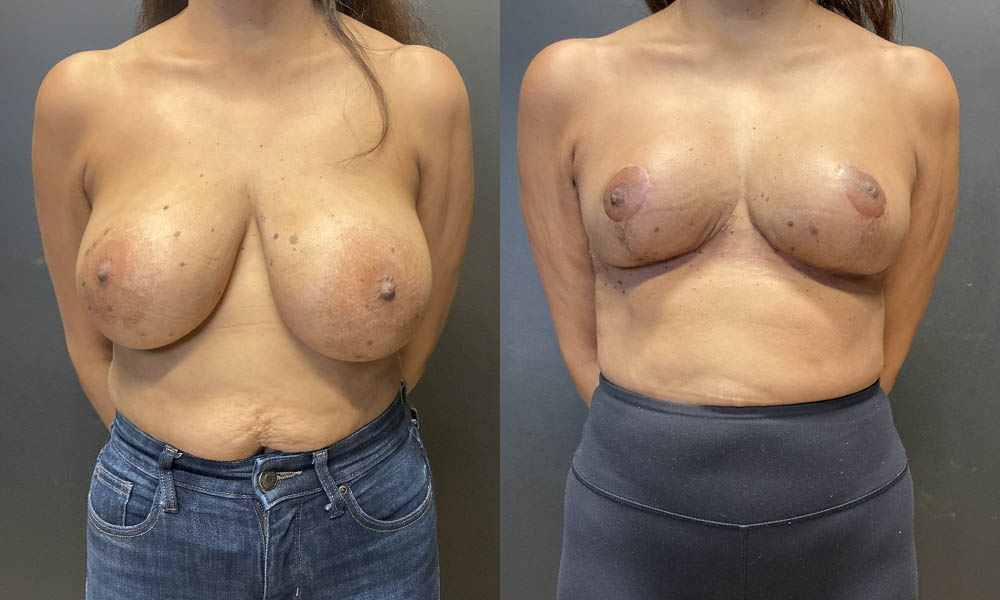 1_0000_AO 8_18_26 Before Anterior.jpg